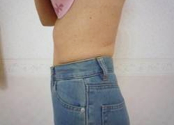 50代女性ウエスト 施術後