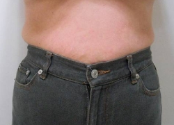 60代女性ウエスト 施術後