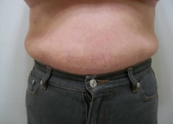 60代女性ウエスト 施術前