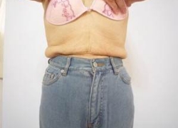 70代女性ウエスト 施術後