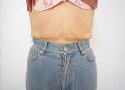 70代女性ウエスト 施術後