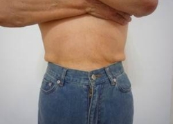 70代女性ウエスト 施術後