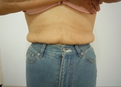 70代女性ウエスト 施術前