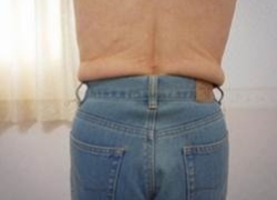 70代女性ウエスト 施術後