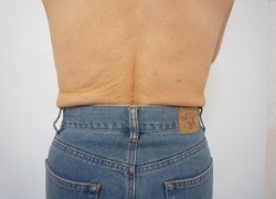 70代女性ウエスト 施術後