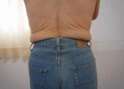 70代女性ウエスト 施術前