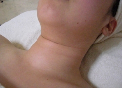 20代女性あご首 施術前