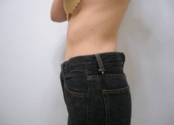 20代ウエスト5回 施術後