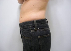 20代女性ウエスト5回 施術前