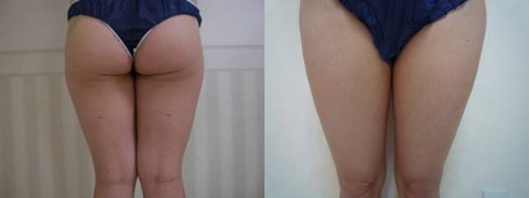 20代女性太もも（正面） 施術前