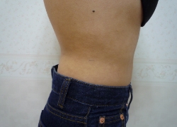 30代女性ウエスト 施術後
