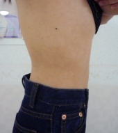 20代女性ウエスト 施術後