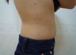 30代女性ウエスト 施術前