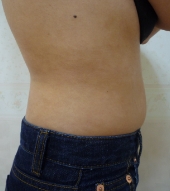 30代女性ウエスト 施術前