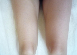 20代女性片足施術 施術前