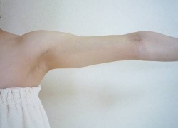 20代二の腕 施術後