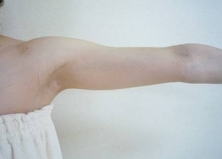 20代女性二の腕 施術前