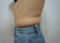 50代女性ウエスト 施術後