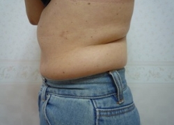 50代女性ウエスト 施術前