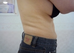 50代ウエスト 施術後