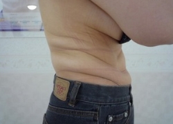 50代女性ウエスト 施術前